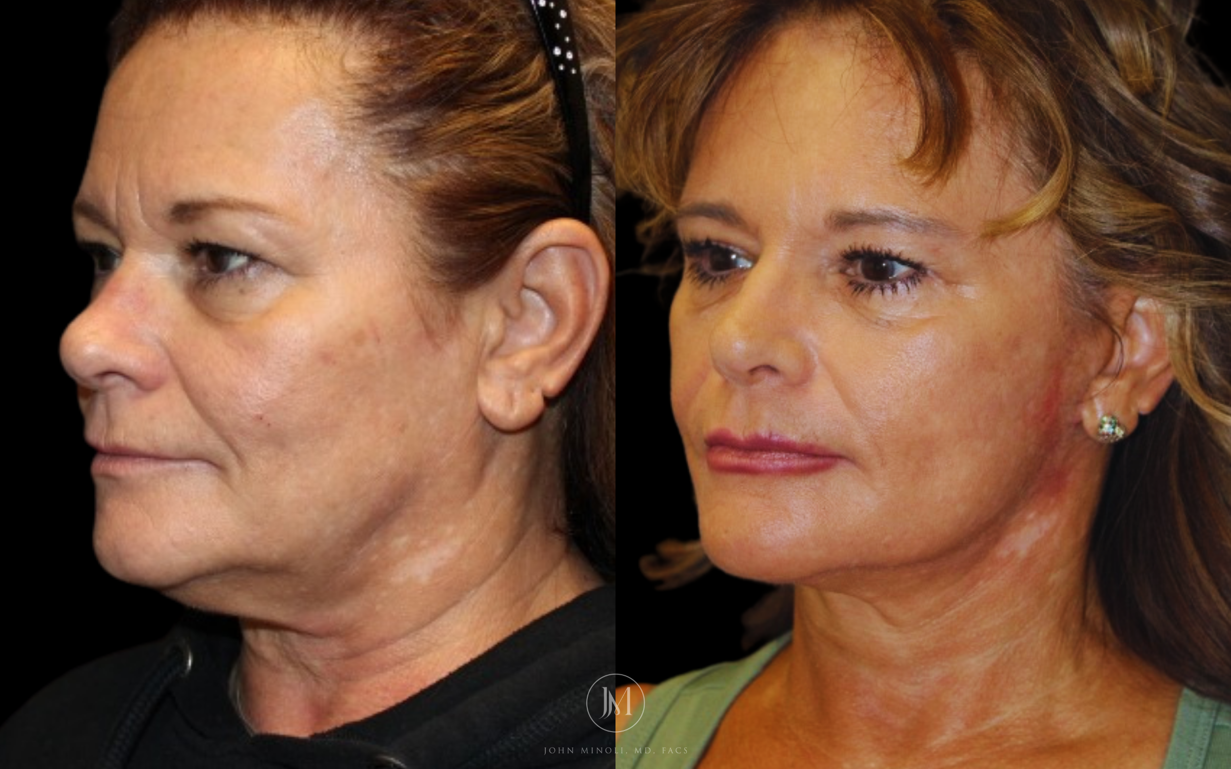 Face and Neck Lift Before and After