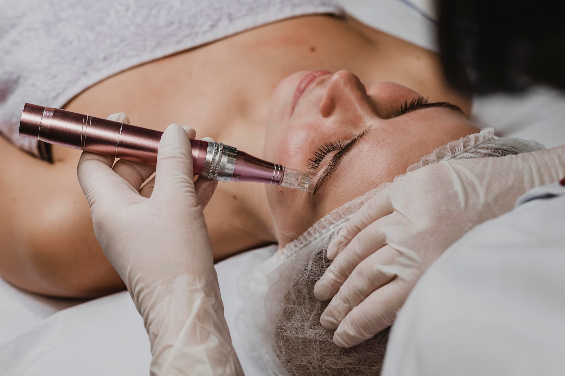 Microneedling image