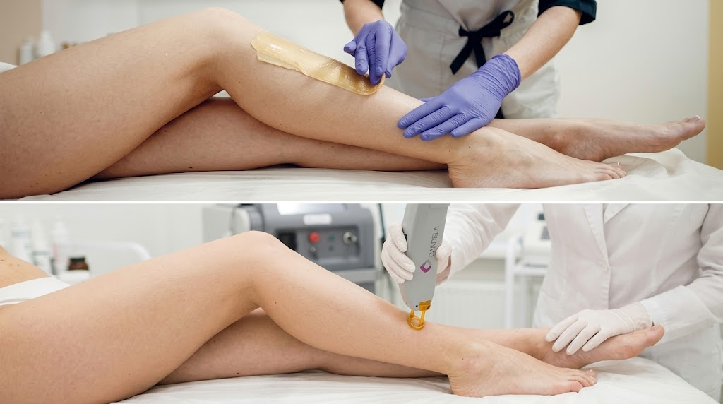 Side-by-side comparison of waxing and laser hair removal treatment at Callista Beauty & Spa