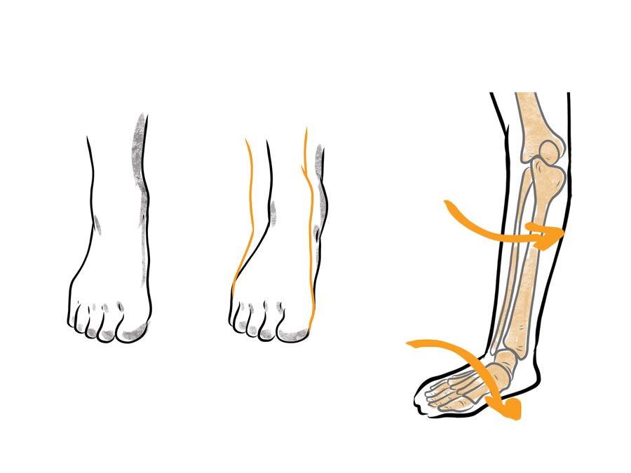 illustration of excessive foot and ankle pronation