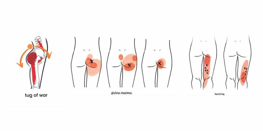 trigger points glutes and hamstrings