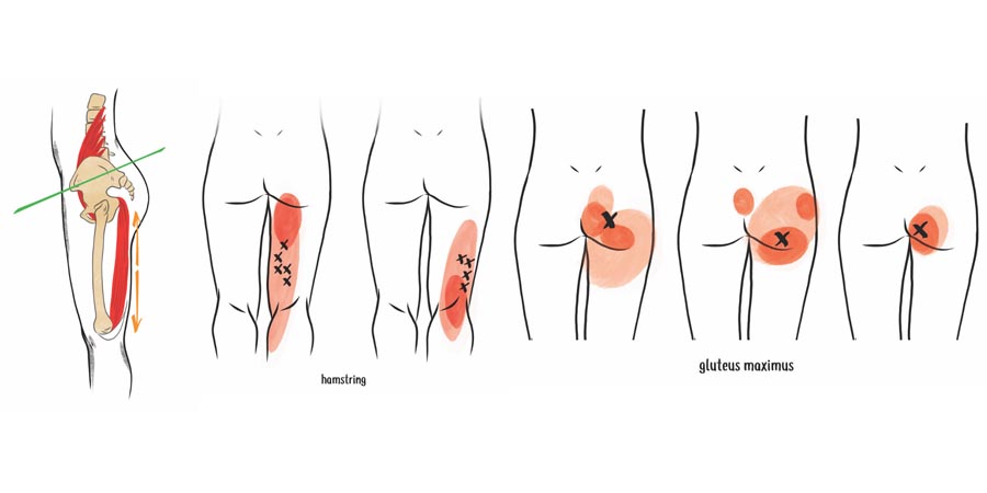 null anatomy illustration of trigger points and referral patterns around the glutes and hamstrings