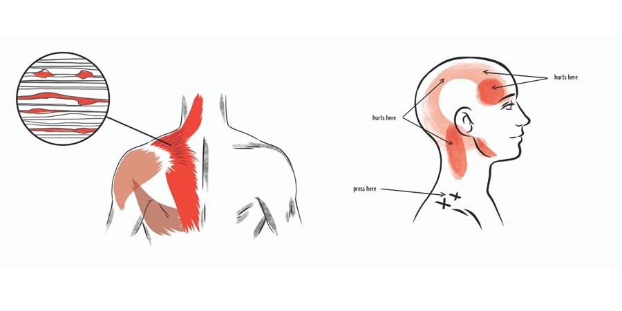 null anatomy illustration of an upper trap trigger point and pain referral patterns
