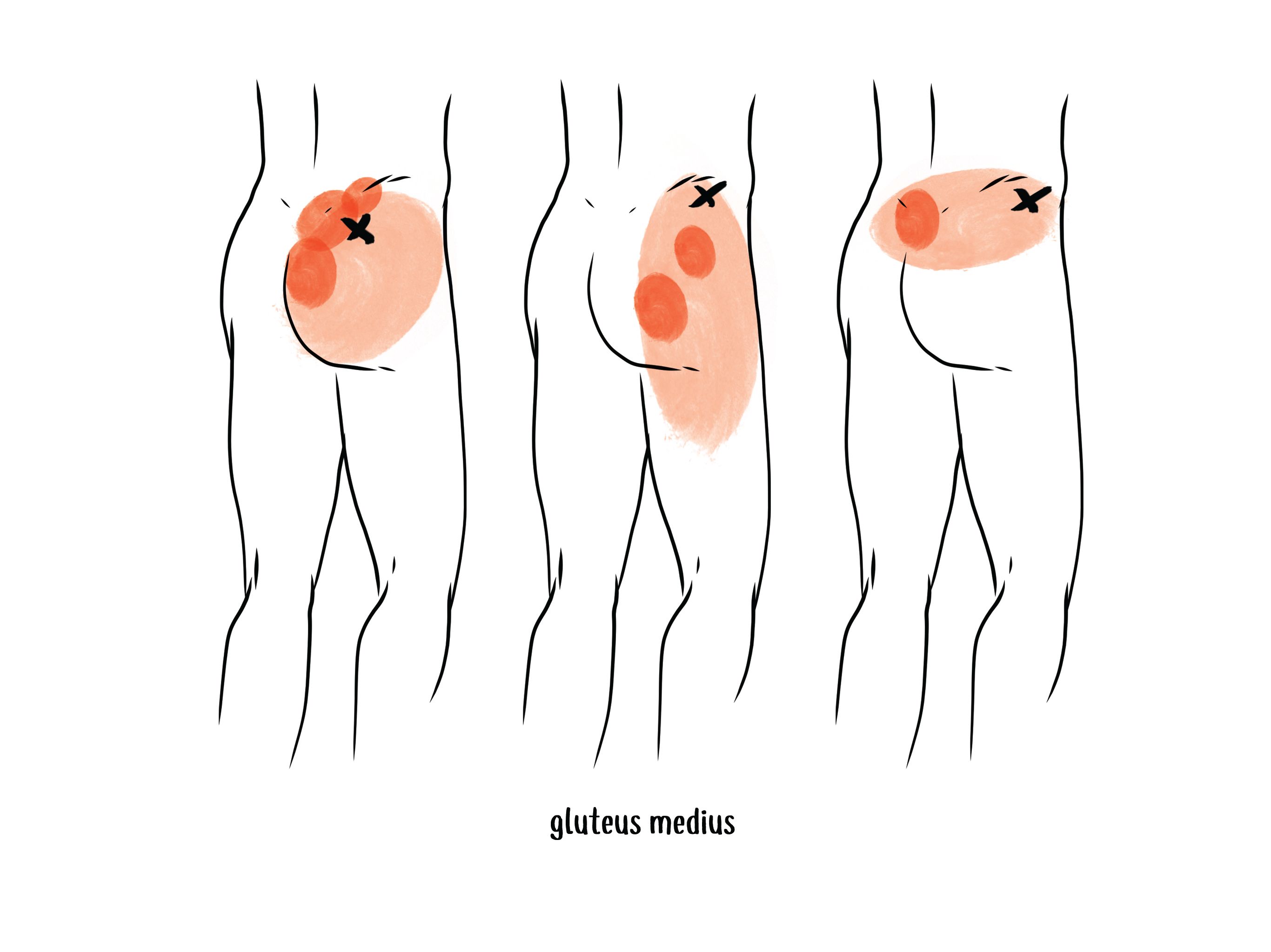 null gluteus medius trigger point locations