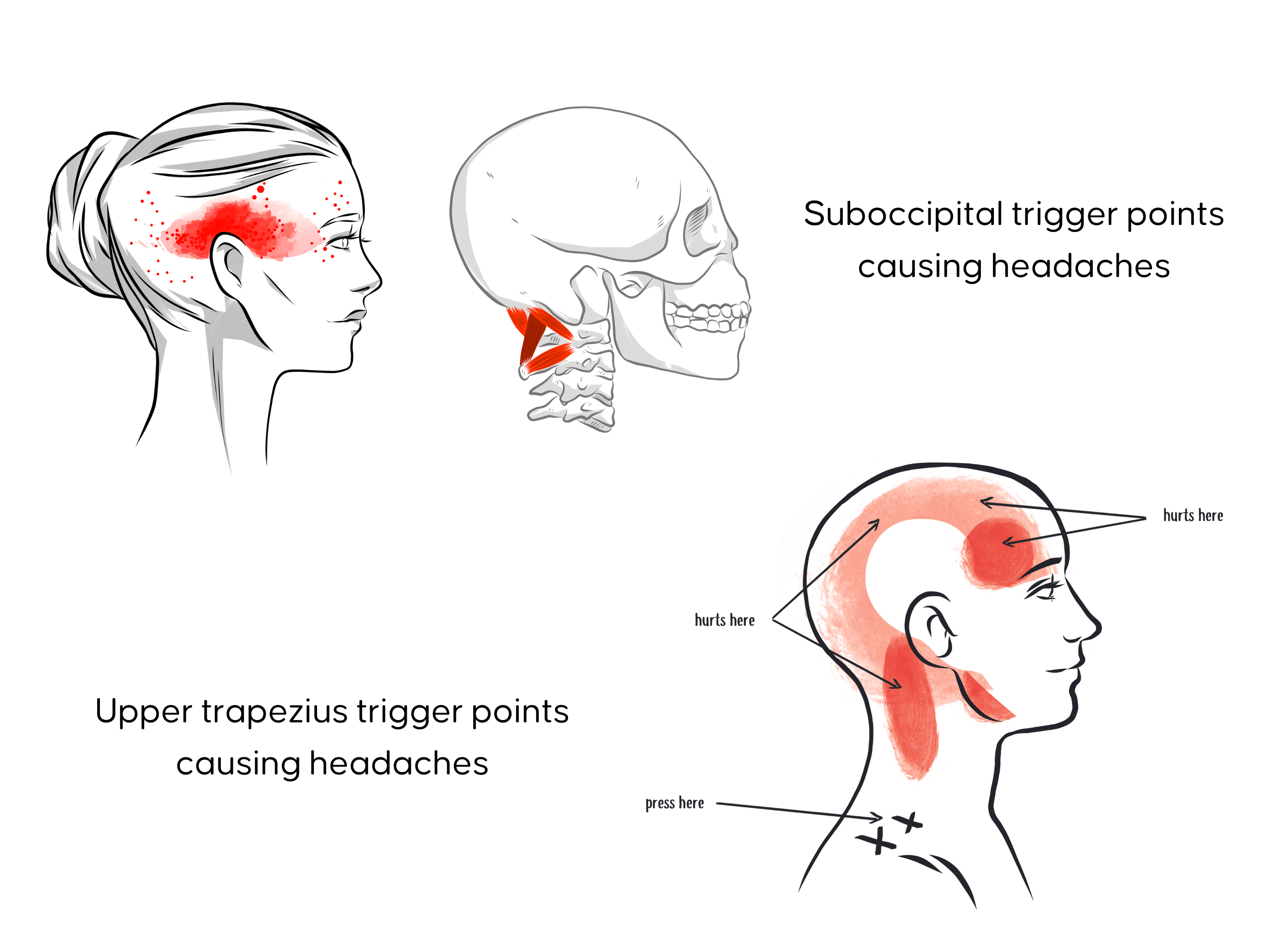 trigger points that cause headaches
