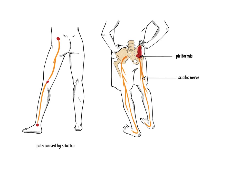 anatomy illustration of a tight piriformis muscle causing sciatica pain