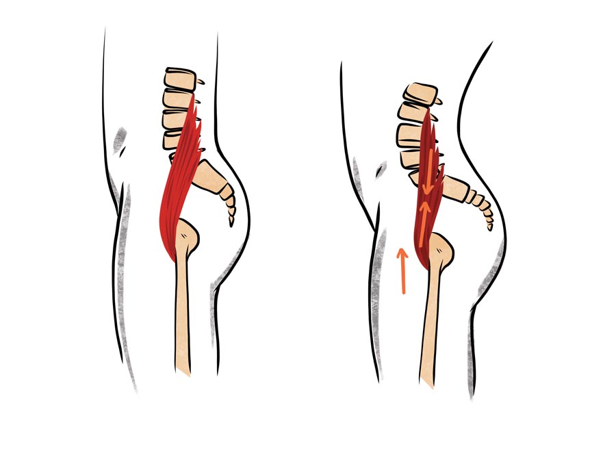 null anatomy illustration of a tight iliopsoas causing lower back arching