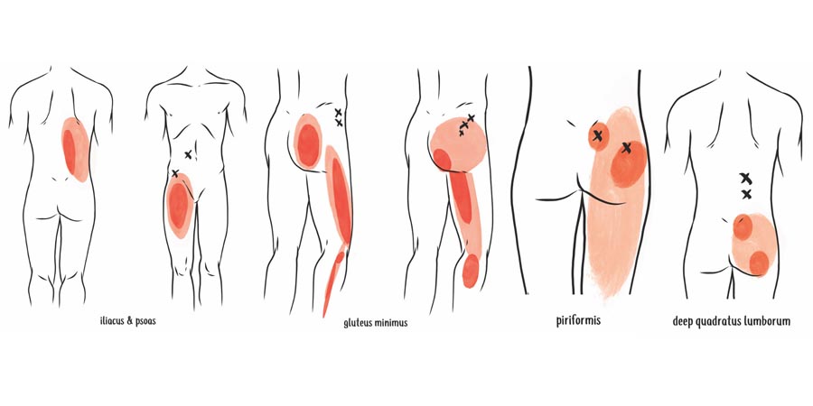 null anatomy illustration of trigger points and referral patterns around the hips and lower back