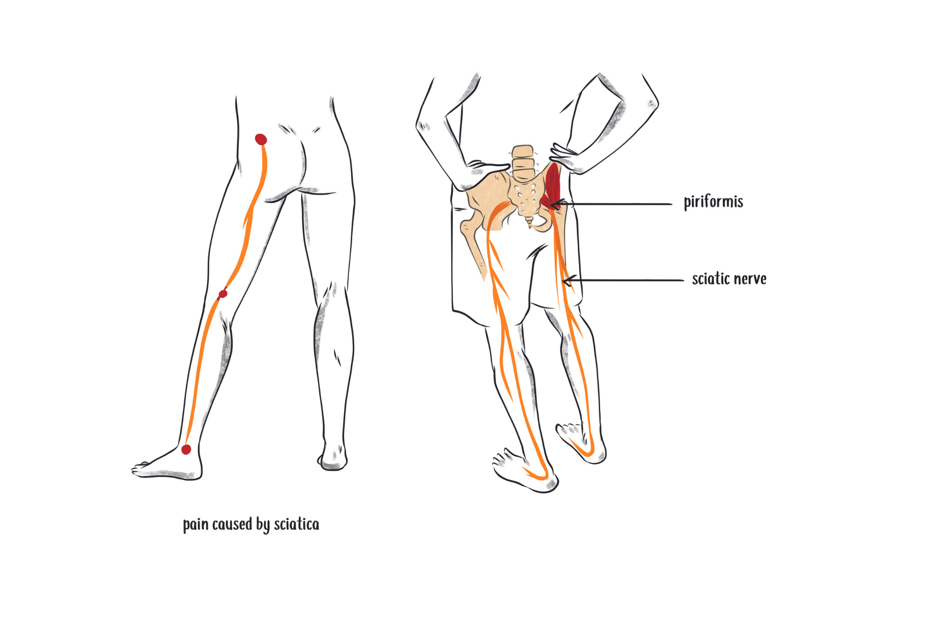 anatomy illustration of sciatica pain