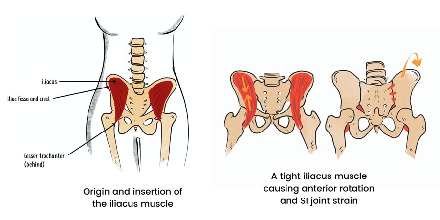 anatomy illustration of how a tight iliacus causes SI joint pain