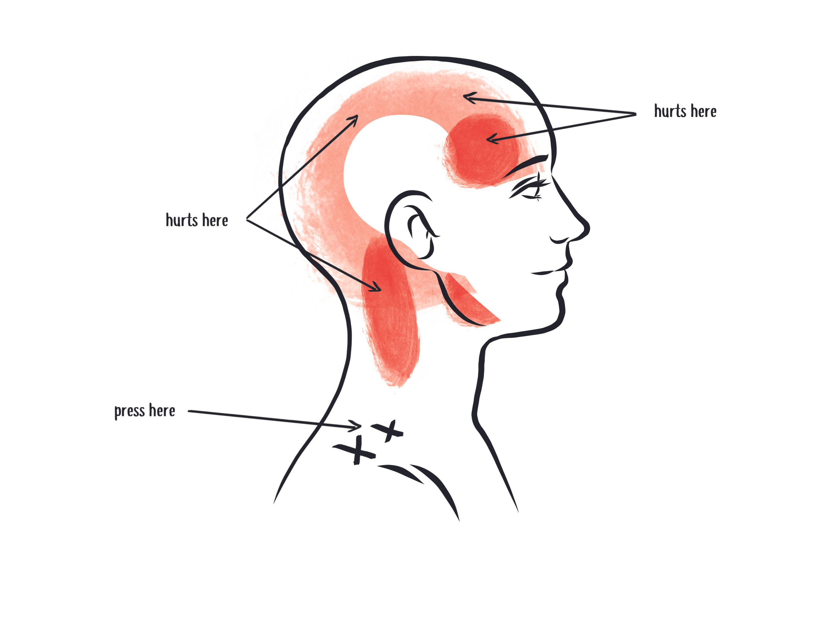 upper trapezius trigger point referral patterns