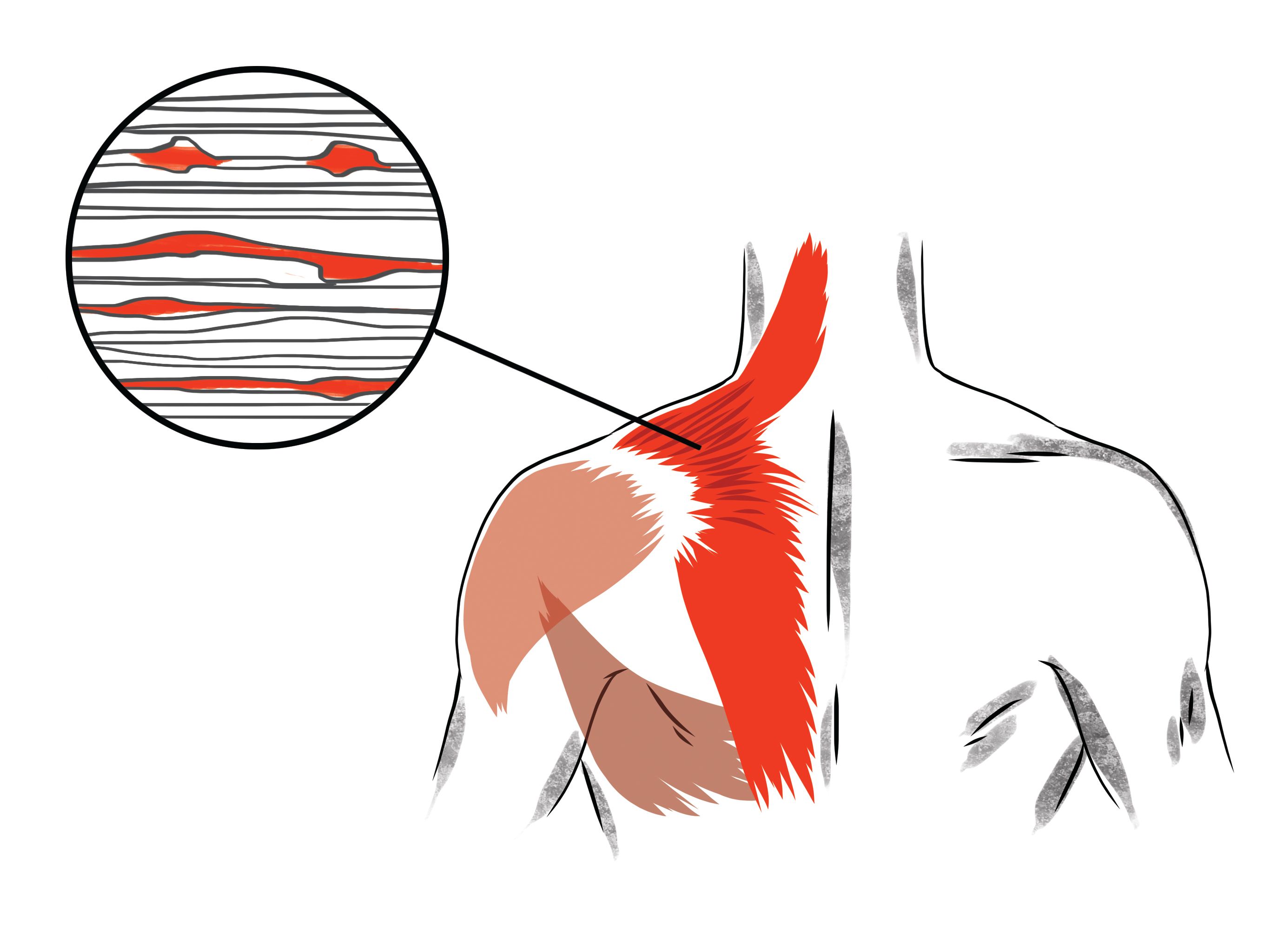 illustration of upper traps trigger points