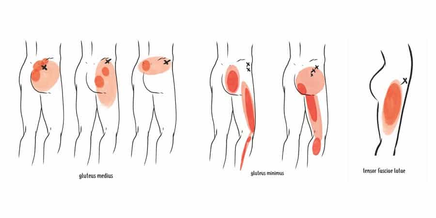 trigger points outer hips