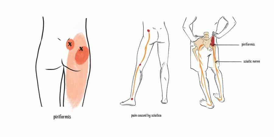 piriformis caused by sciatica