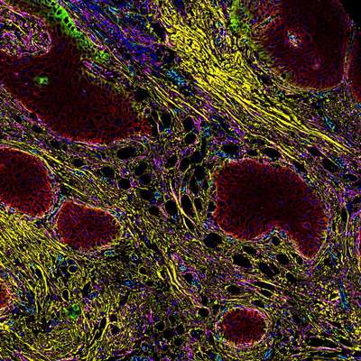 A multicolor microscopic view of tumor cells, showcasing intricate biological details.