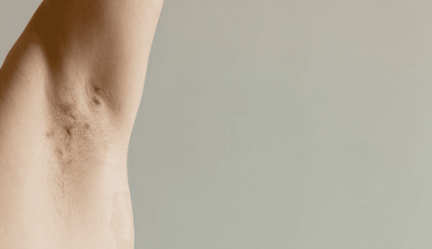 Semaglutide for Hidradenitis in Obese Patients